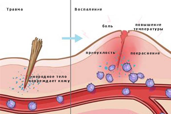 inflammation_ru
