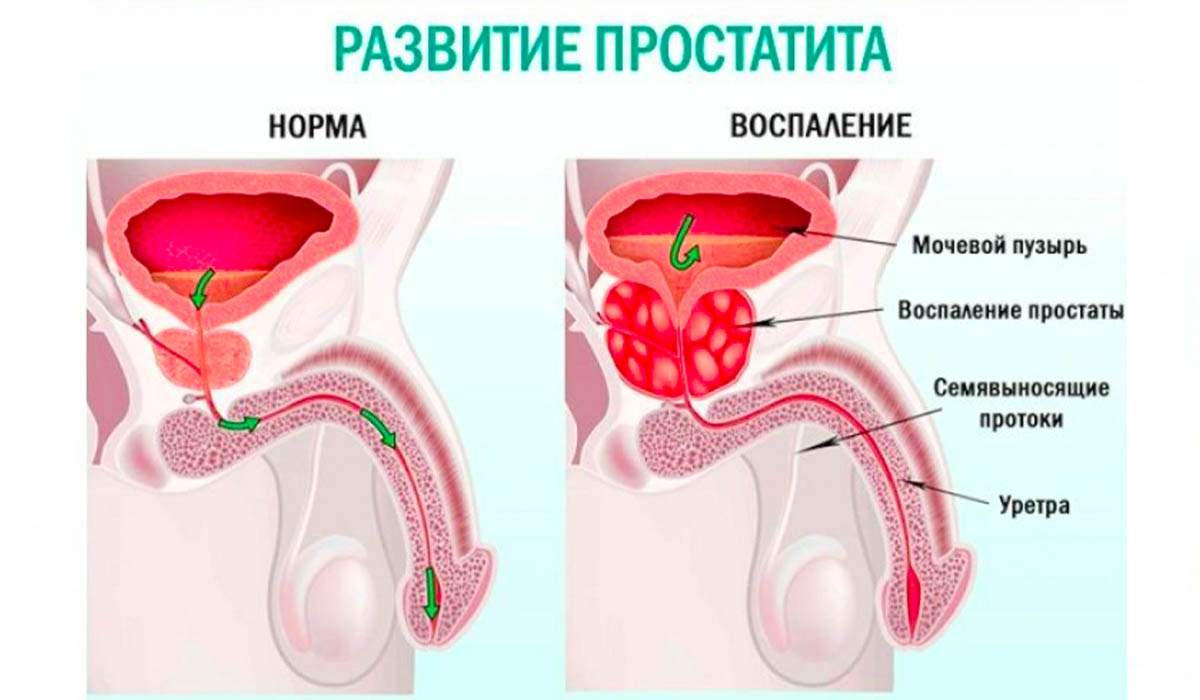 prostatit_3