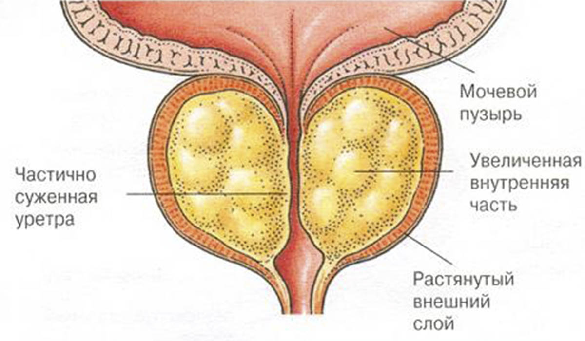 prostatit_6