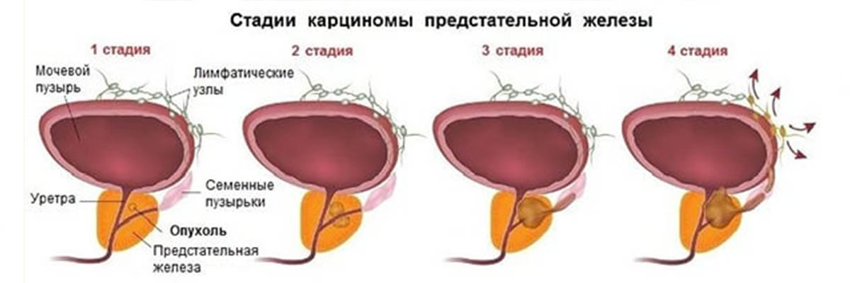 prostatit_8