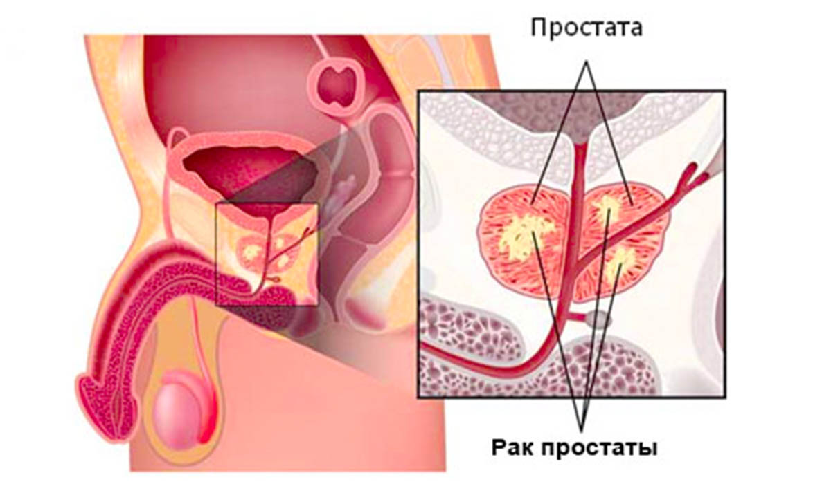 rak-prostaty